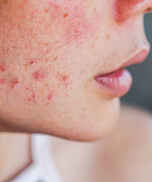 Cicatrici da acne: Lipogems e laser CO2, i risultati di uno studio di Image Regenerative Clinic